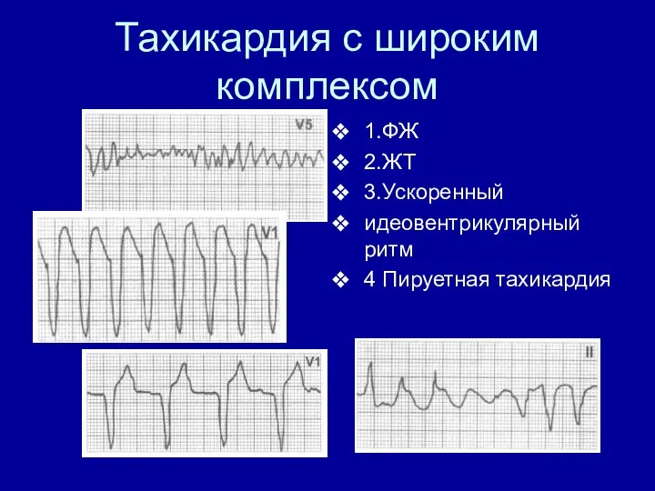 Тахикардия с широким комплексом 1.ФЖ 2.ЖТ 3.Ускоренный идеовентрикулярный ритм 4 Пируетная тахикардия