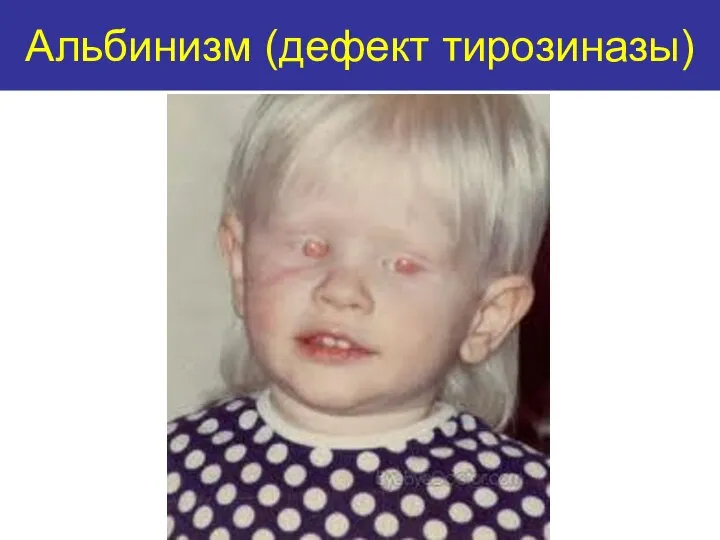 Альбинизм (дефект тирозиназы)