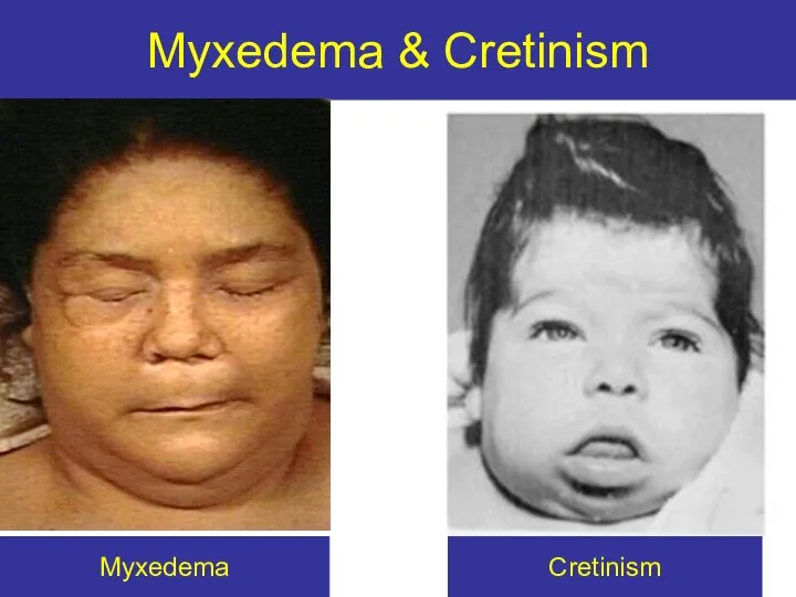 Myxedema & Cretinism Myxedema Cretinism