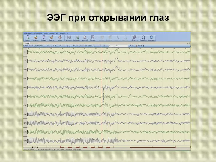 ЭЭГ при открывании глаз