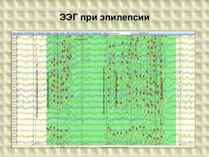 ЭЭГ при эпилепсии