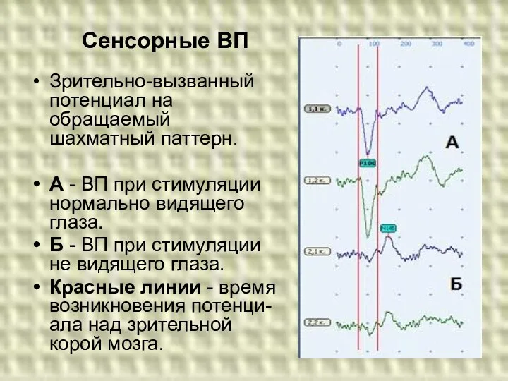 Зрительно-вызванный потенциал на обращаемый шахматный паттерн. А - ВП при стимуляции