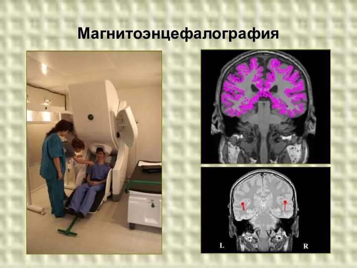 Магнитоэнцефалография