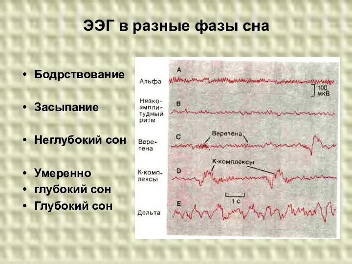 ЭЭГ в разные фазы сна Бодрствование Засыпание Неглубокий сон Умеренно глубокий сон Глубокий сон