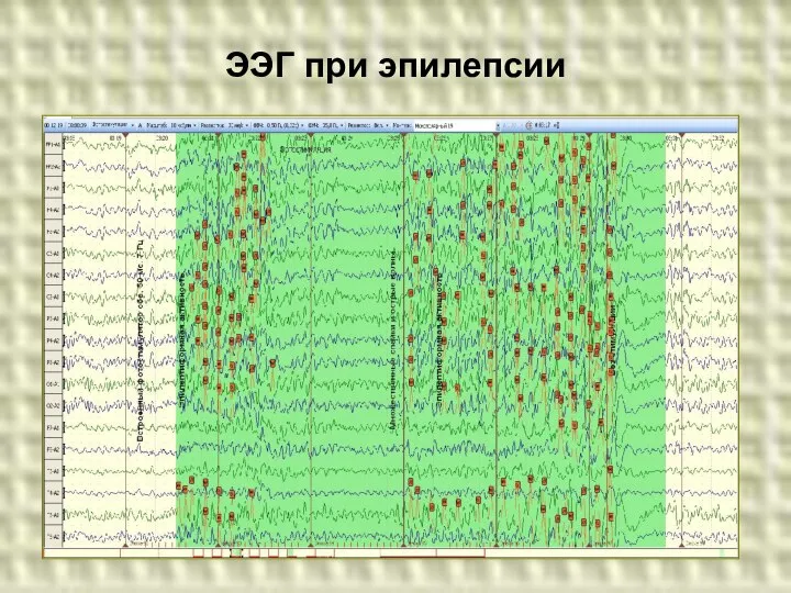 ЭЭГ при эпилепсии