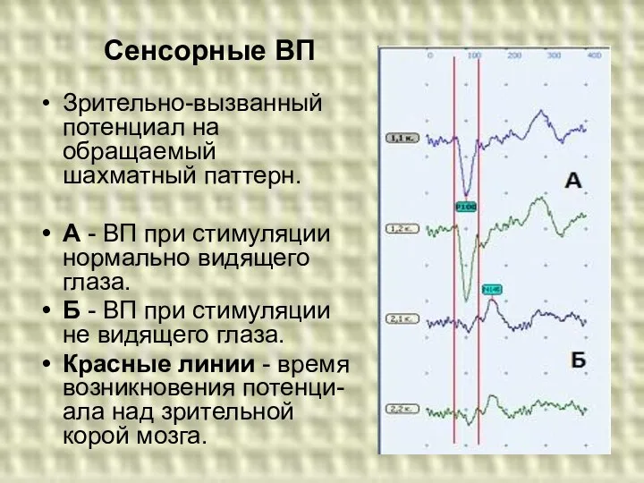 Зрительно-вызванный потенциал на обращаемый шахматный паттерн. А - ВП при стимуляции