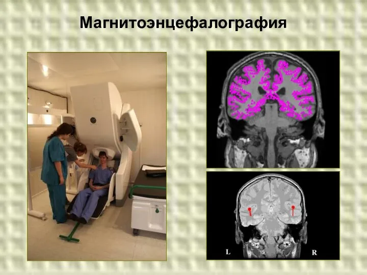 Магнитоэнцефалография