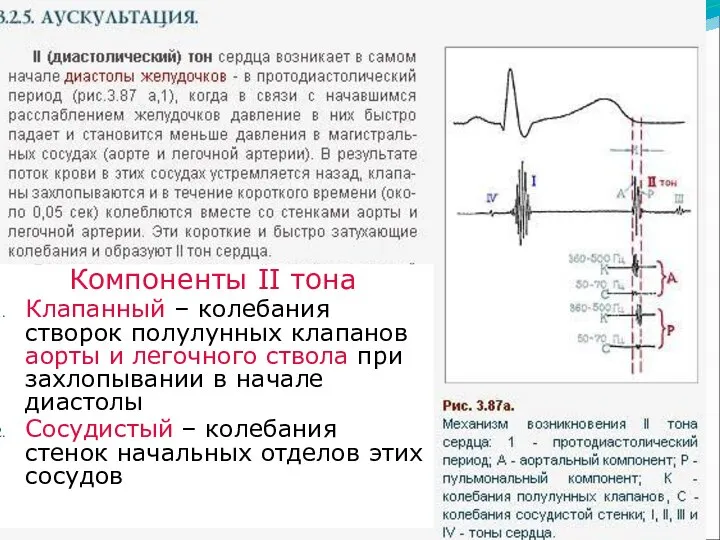 Компоненты II тона Клапанный – колебания створок полулунных клапанов аорты и