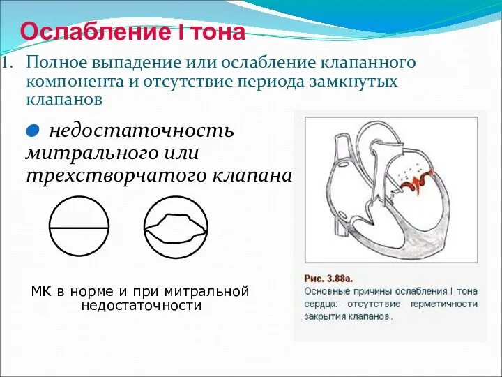 Ослабление I тона Полное выпадение или ослабление клапанного компонента и отсутствие