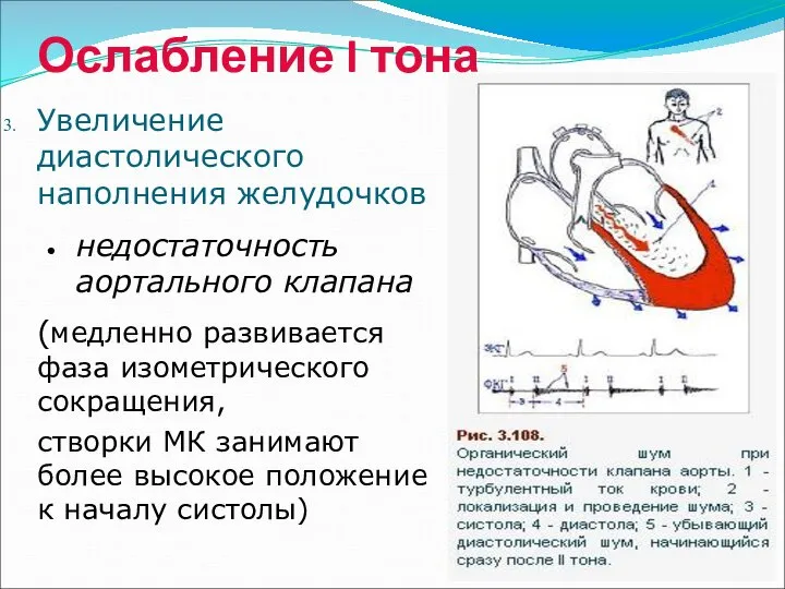 Ослабление I тона Увеличение диастолического наполнения желудочков недостаточность аортального клапана (медленно