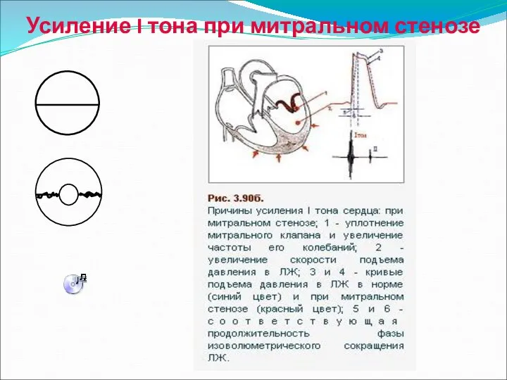 Усиление I тона при митральном стенозе