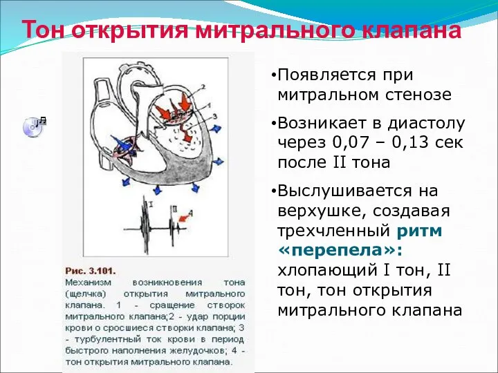 Тон открытия митрального клапана Появляется при митральном стенозе Возникает в диастолу