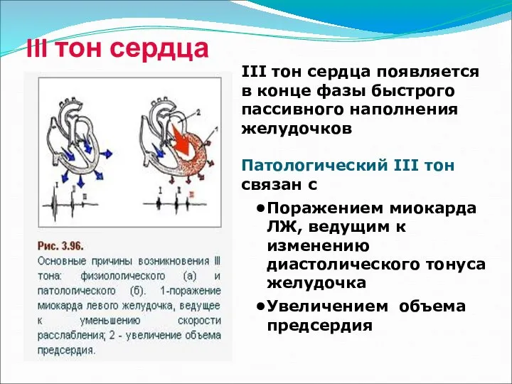 III тон сердца III тон сердца появляется в конце фазы быстрого