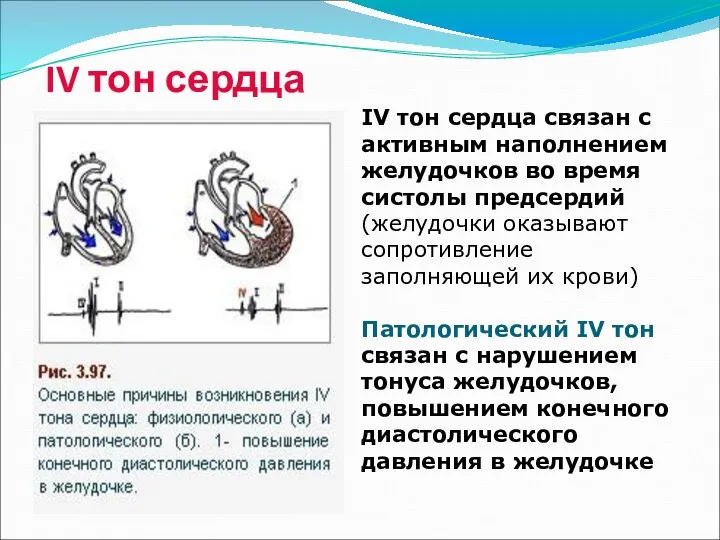 IV тон сердца IV тон сердца связан с активным наполнением желудочков