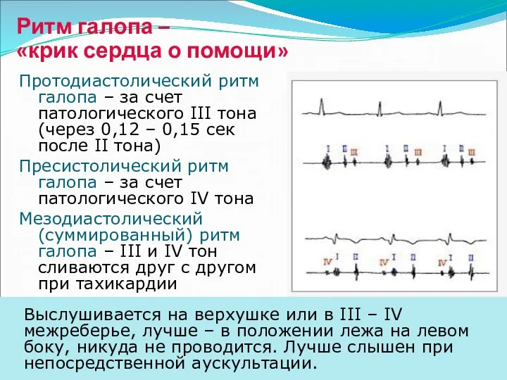 Ритм галопа – «крик сердца о помощи» Протодиастолический ритм галопа –