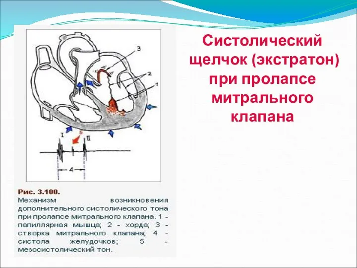 Систолический щелчок (экстратон) при пролапсе митрального клапана