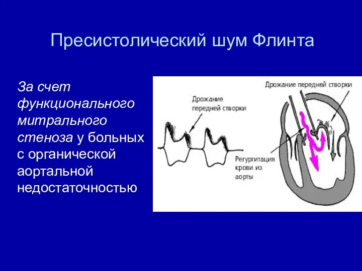 Пресистолический шум Флинта За счет функционального митрального стеноза у больных с органической аортальной недостаточностью