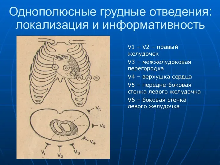 Однополюсные грудные отведения: локализация и информативность V1 – V2 – правый