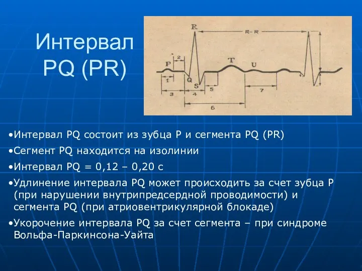 Интервал PQ (PR) Интервал PQ состоит из зубца P и сегмента