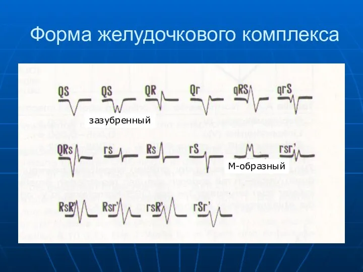 Форма желудочкового комплекса М-образный зазубренный