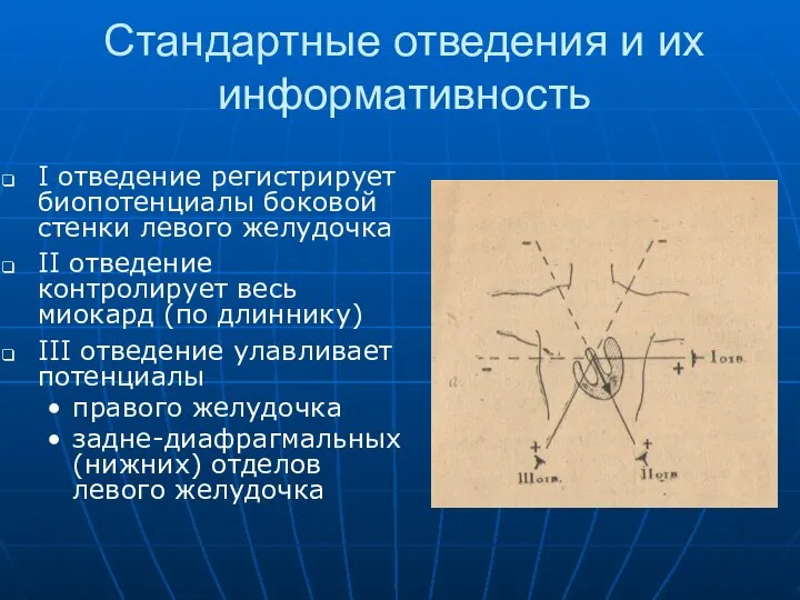 Стандартные отведения и их информативность I отведение регистрирует биопотенциалы боковой стенки