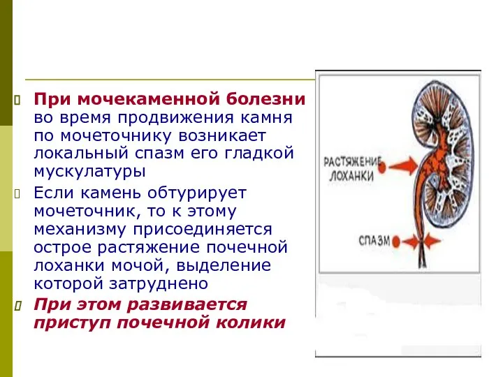 При мочекаменной болезни во время продвижения камня по мочеточнику возникает локальный