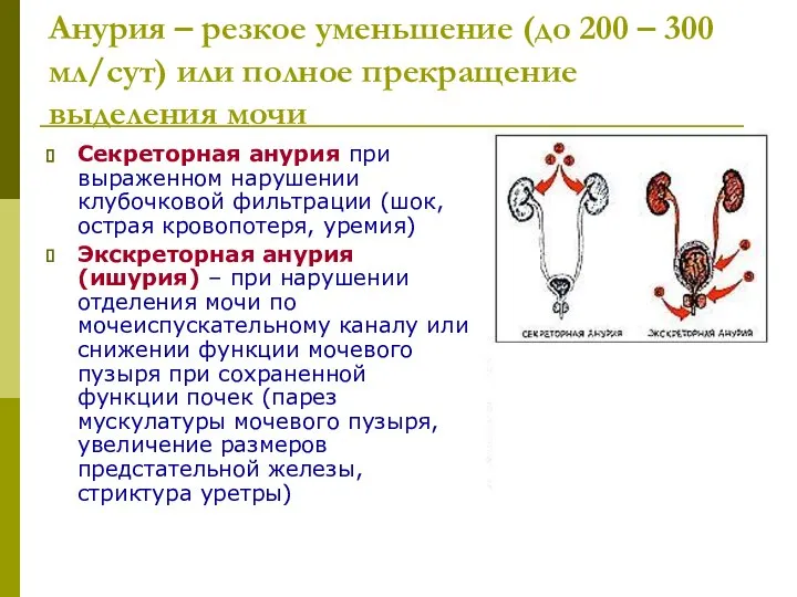 Анурия – резкое уменьшение (до 200 – 300 мл/сут) или полное