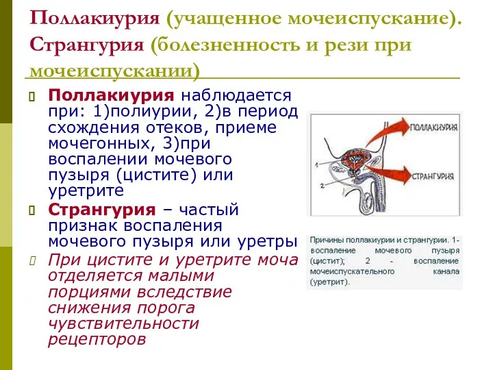 Поллакиурия (учащенное мочеиспускание). Странгурия (болезненность и рези при мочеиспускании) Поллакиурия наблюдается