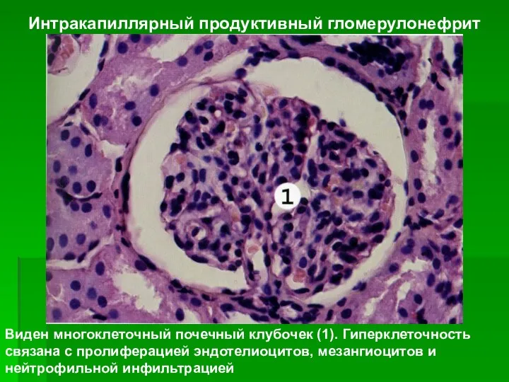 Виден многоклеточный почечный клубочек (1). Гиперклеточность связана с пролиферацией эндотелиоцитов, мезангиоцитов