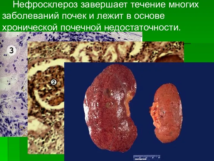 Нефросклероз завершает течение многих заболеваний почек и лежит в основе хронической почечной недостаточности.