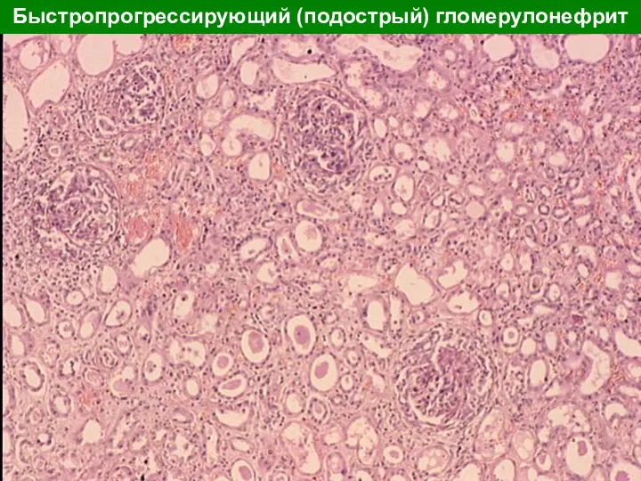 Быстропрогрессирующий (подострый) гломерулонефрит