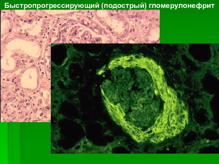 Быстропрогрессирующий (подострый) гломерулонефрит