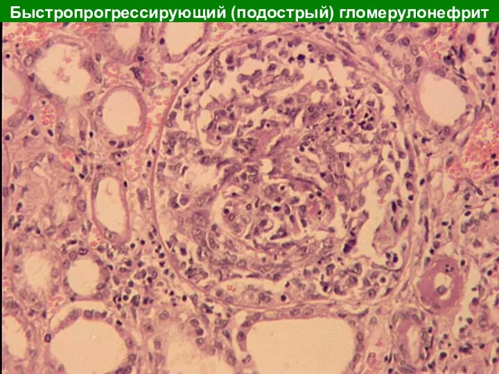 Быстропрогрессирующий (подострый) гломерулонефрит