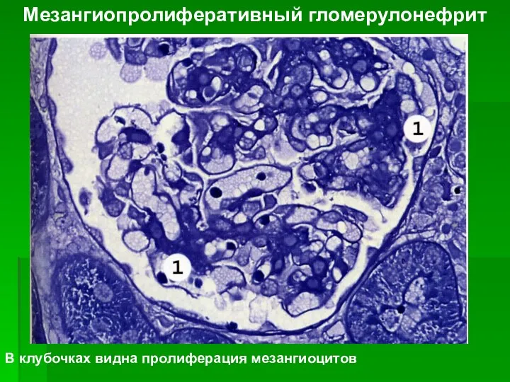 Мезангиопролиферативный гломерулонефрит В клубочках видна пролиферация мезангиоцитов