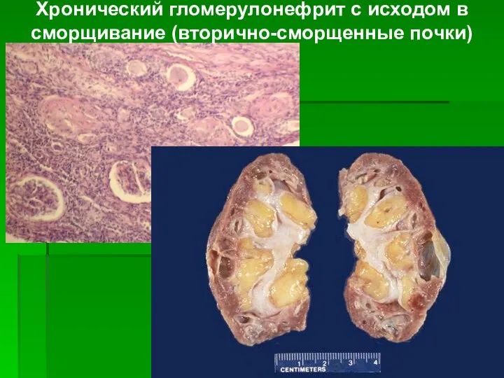 Хронический гломерулонефрит с исходом в сморщивание (вторично-сморщенные почки)