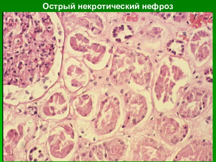 Острый некротический нефроз