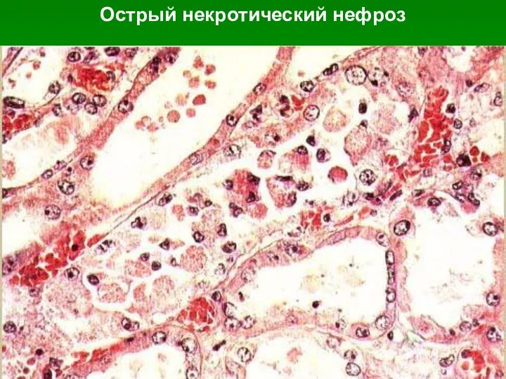 Острый некротический нефроз