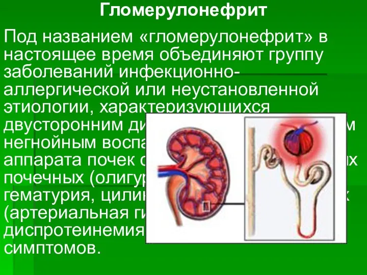 Гломерулонефрит Под названием «гломерулонефрит» в настоящее время объединяют группу заболеваний инфекционно-аллергической