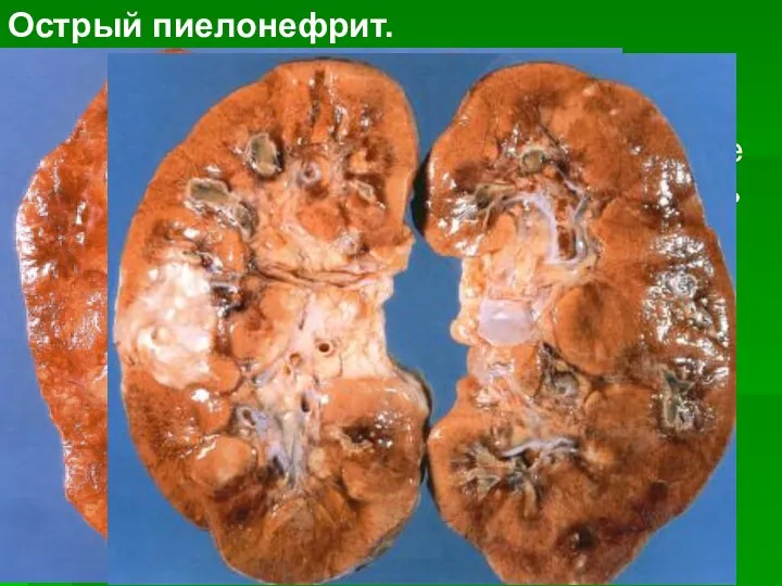 Острый пиелонефрит. В почке — гнойное воспаление, часто с абсцедированием. В