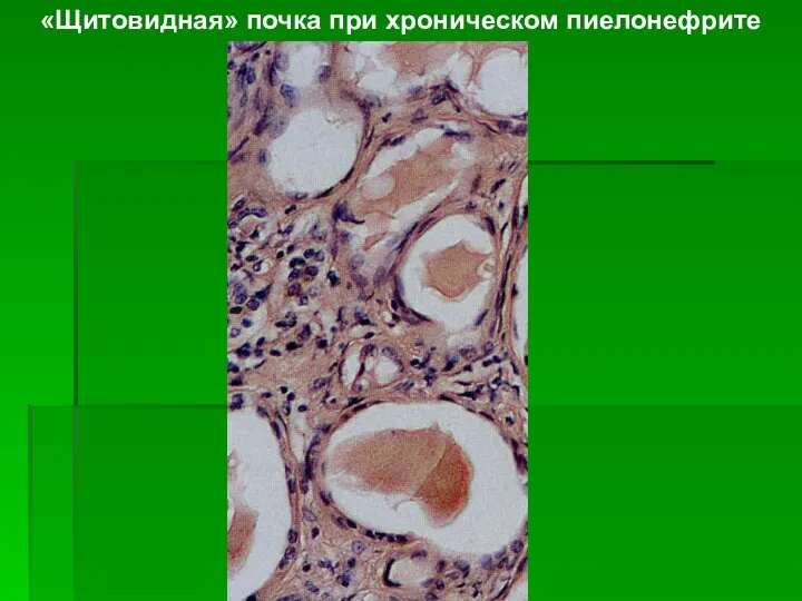 «Щитовидная» почка при хроническом пиелонефрите