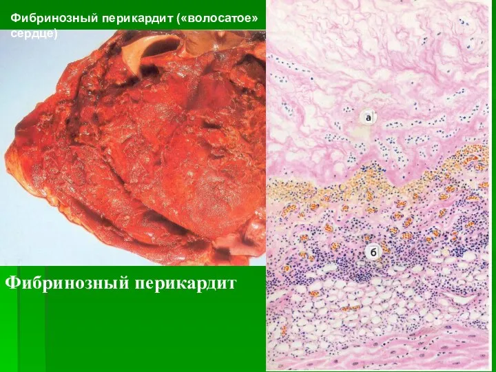 Фибринозный перикардит («волосатое» сердце) Фибринозный перикардит