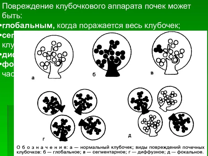 Повреждение клубочкового аппарата почек может быть: глобальным, когда поражается весь клубочек;