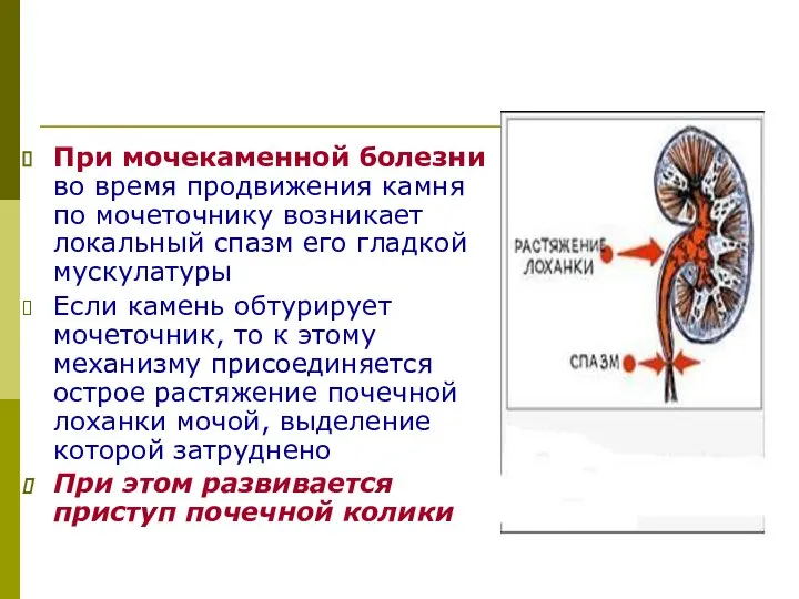 При мочекаменной болезни во время продвижения камня по мочеточнику возникает локальный