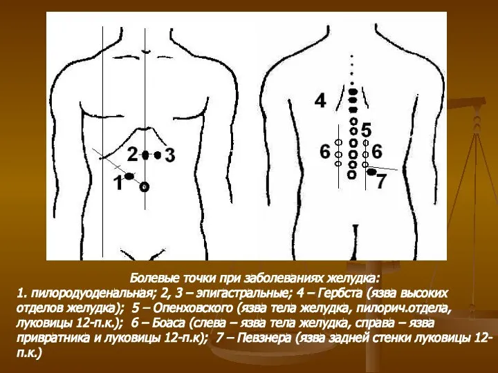 Болевые точки при заболеваниях желудка: 1. пилородуоденальная; 2, 3 – эпигастральные;