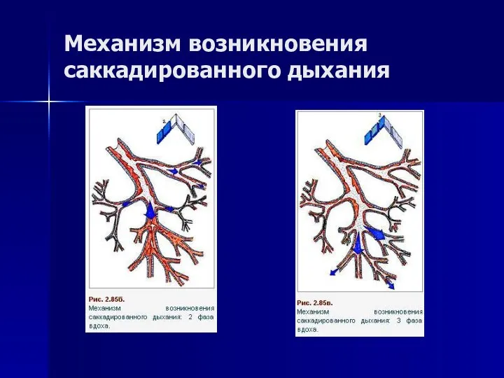 Механизм возникновения саккадированного дыхания