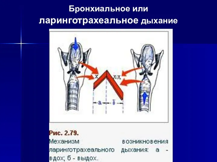 Бронхиальное или ларинготрахеальное дыхание