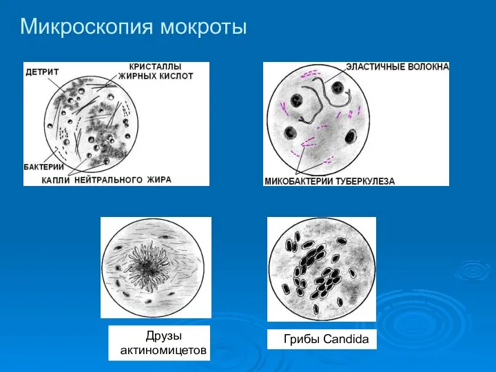 Друзы актиномицетов Грибы Candida Микроскопия мокроты