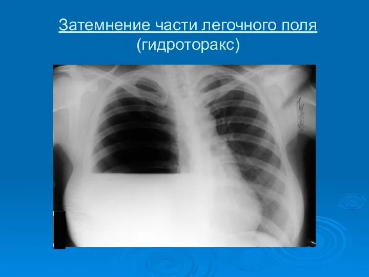 Затемнение части легочного поля (гидроторакс)