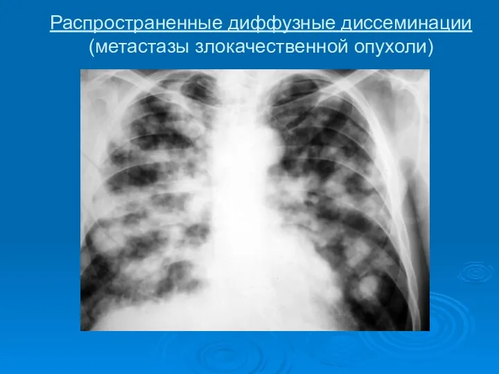 Распространенные диффузные диссеминации (метастазы злокачественной опухоли)