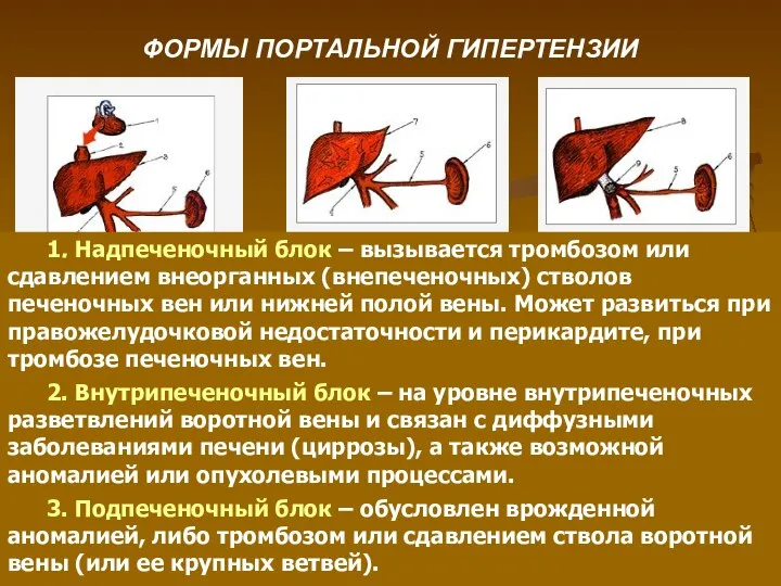 ФОРМЫ ПОРТАЛЬНОЙ ГИПЕРТЕНЗИИ 1. Надпеченочный блок – вызывается тромбозом или сдавлением